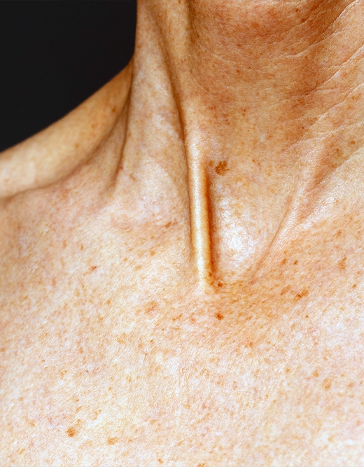 Adana Keratosis Pilaris Adana, Adana Keratosis Pilaris Tedavisi, Keratosis Pilaris Lazerle Tedavi Adana, Keratosis Pilaris Lazerle Geçer Mi, Adana Keratosis Pilaris Doktor, Adana Tavuk Derisi Hastalığı, Tavuk Derisi Görünümü Lazerle Geçer Mi, Tavuk Derisi Hastalığı Nedenleri