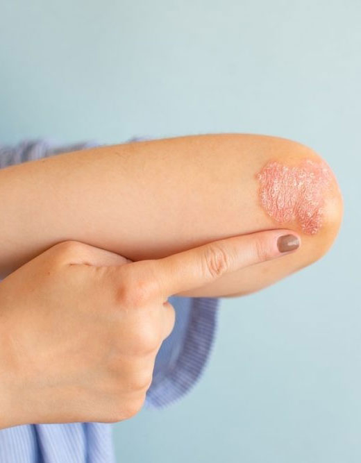 PSORİAZİS (SEDEF HASTALIĞI)